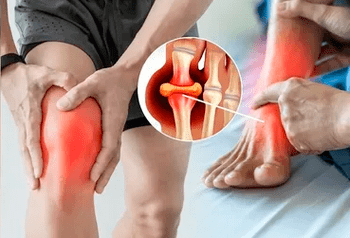 Esquema para aplicar gel Icexin en la zona de la articulación de la rodilla y el pie.