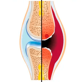 La estructura de una articulación sana y desgastada con la designación de tejido cartilaginoso y líquido sinovial.
