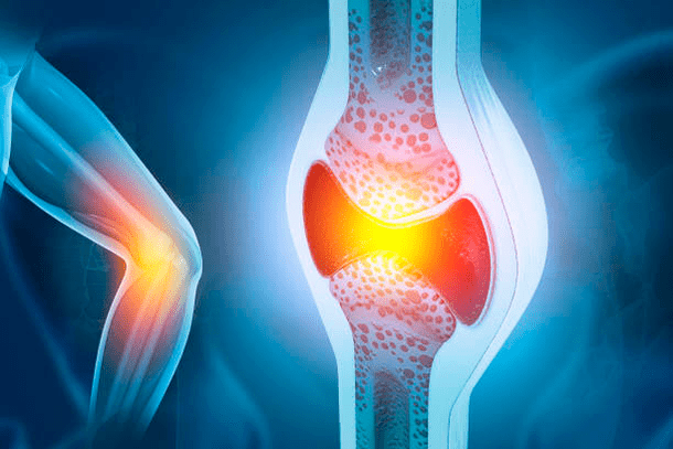 Prevención de enfermedades de las articulaciones.
